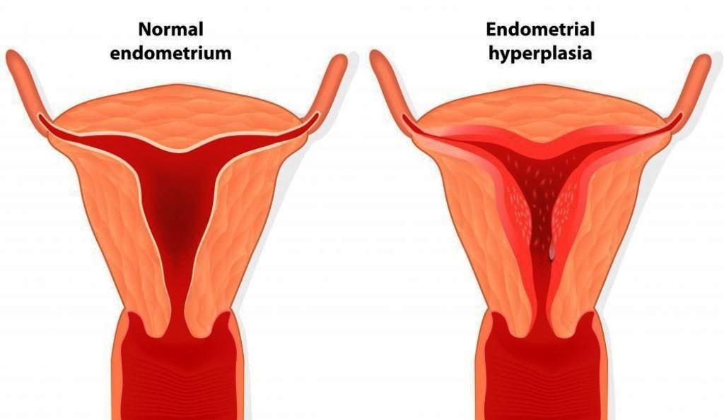 Endometrial Hiperplazi Rahim Duvar Kal nla mas Prof Dr Ate 